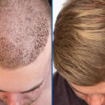 Hair Transplant