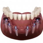 Dental Implant Accessories
